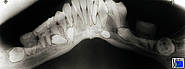 Hyperodontie mit Zahnretentionen. Im Unterkiefer sind vier überzählige Zähne impaktiert. Die vorhandenen Weisheitszähne sind noch nicht durchgebrochen.