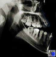 Die Fernröntgenaufnahme zeigt eine mandibuläre Prognathie mit offenem Biss.