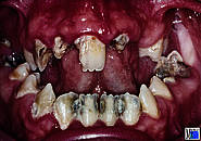 Mandibuläre Prognathie mit offenem Biss. Extremer Gebissverfall bei Zahnbehandlungsphobie. Eine Behandlung war nur in Narkose möglich.