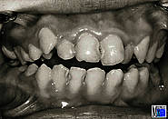 Mundöffnungsmöglichkeit vor und nach der Operation