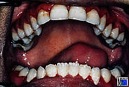 Optimale Okklusion und Mundöffnungsmöglichkeit nach Abschluss der Behandlung
