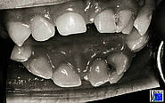 Verschmelzung der beiden Milchzähne 61, 61 mit einem überzähligen Zahn (Sammlung Frau Dr. A. Gentz, Bonn)