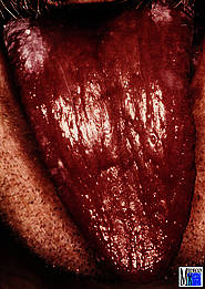 HIV-assoziierte erythematös-atrophische Candidiasis mit Haarleukoplakie an den dorsalen Zungenrändern. Aus Becker, J.: Rhein. Zahnärztebl. 10: 21 (1987)