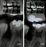 Kariesverlauf am Zahn