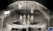 Extreme Hypodontie bei einem 5-jährigen Jungen. Vier obere Zähne und ein unterer Zahn sind durchgebrochen. Im Ober- und Unterkiefer befinden sich je zwei weitere Zahnanlagen. (Sammlung Frau Dr. A. Gentz, Bonn)