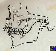Breite Ankylose des Kiefergelenks und des Processus muscularis mit Hypoplasie des Unterkiefers (Vogelgesicht)