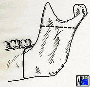 Sagittale Spaltung des aufsteigenden Unterkieferastes nach Obwegeser-Dal Pont zur Behandlung einer mandibulären Retrognathie