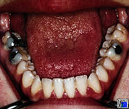 Mandibuläre Prognathie mit Makroglossie. Die Zunge füllt den gesamten Mundbodenraum aus und liegt beim Zusammenbiss zwischen den Zahnreihen