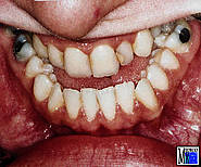 Mandibuläre Prognathie mit Makroglossie. Die Zunge füllt den gesamten Mundbodenraum aus und liegt beim Zusammenbiss zwischen den Zahnreihen