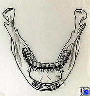 Ostektomie am Alveolarfortsatz in Höhe der ersten Prämolaren und am Kinnrand nach Spiessl