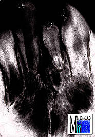 Retinierter Mesiodens im Oberkiefer zwischen den beiden mittleren Schneidezähnen