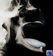 Fernröntgenaufnahme mit ausgeprägter Prognathie des Unterkiefers
