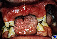 Situation nach Zahnsanierung und operativer Rückverlagerung des Unterkiefers mit Ausgleich des offenen Bisses