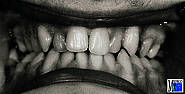 Okklusion nach Ostektomie im Bereich der seitlichen Zahnlücken (Dingman) und Rückverlagerung des Unterkiefers