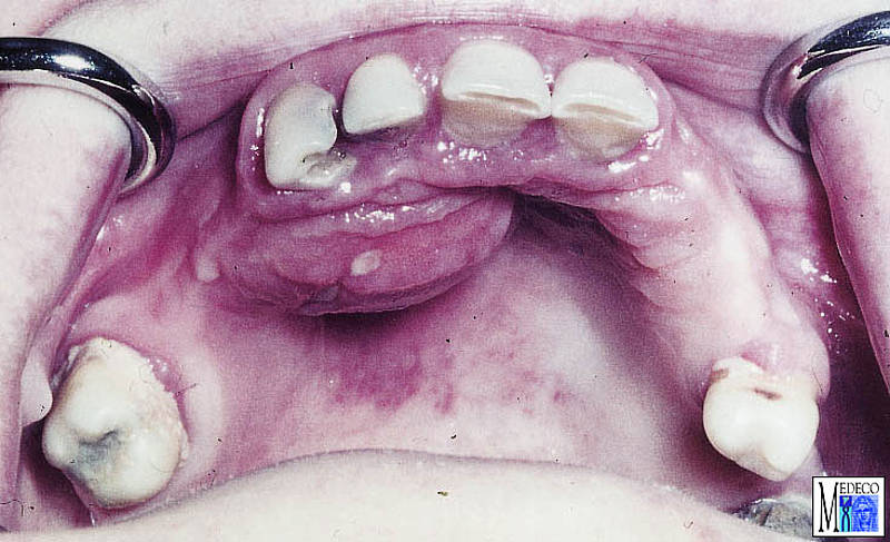 abscess dental abscesses oral surgery subcutaneous sublingual dentistry