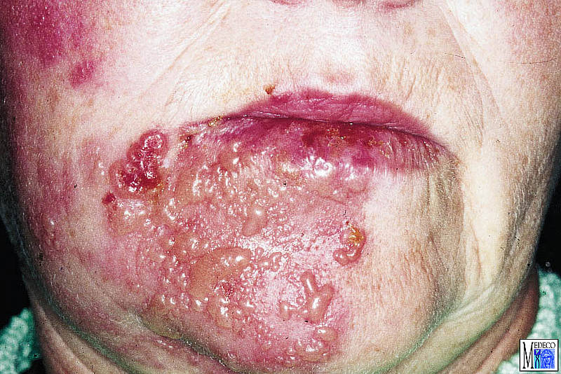 Herpes on head of penis - Herpes - MedHelp