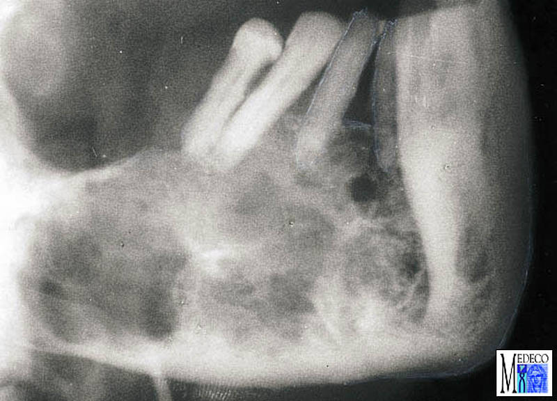 Odontogene Tumoren