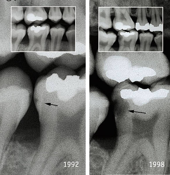 diagnostic-de-la-carie