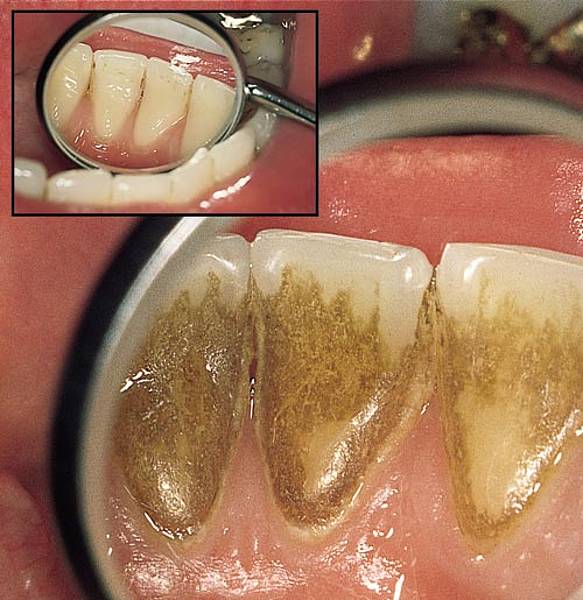 tartar removal tartar removal tartar removal tartar removal