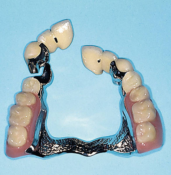 Partial denture vs bridge cost image
