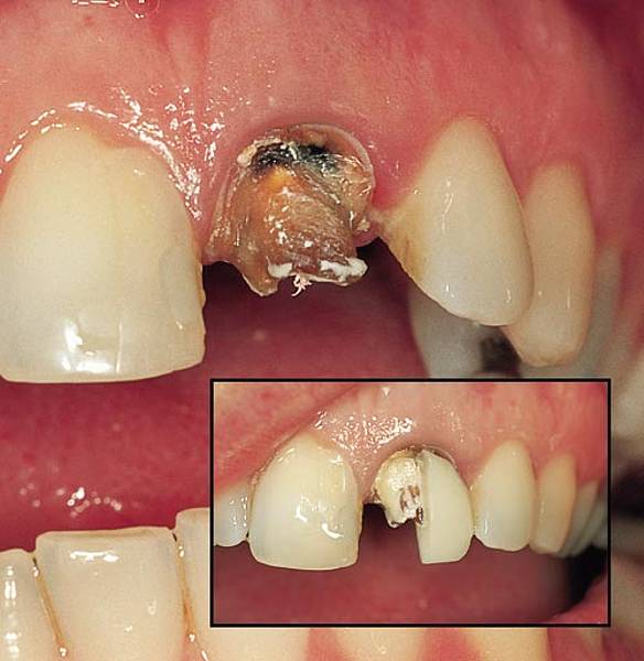 Peg and stump structures