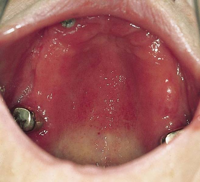 pateint istruction, prob, solution-complete denture insertion