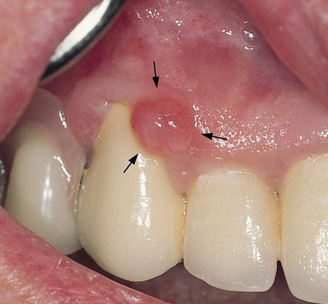 Common Lumps And Bumps In The Mouth - Dear Doctor