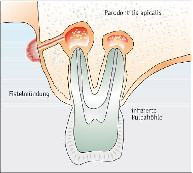 Watch How to Diagnose a Fistula video Watch How to Diagnose a Fistula video