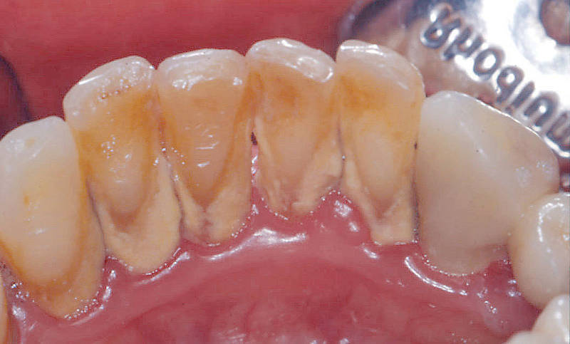 tartar removal tartar removal tartar removal tartar removal