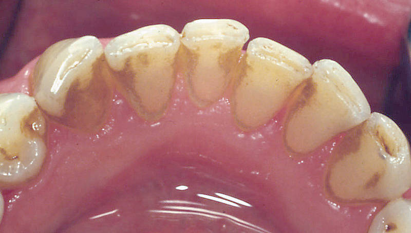tartar removal tartar removal tartar removal tartar removal