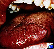 Fibrom der Zunge