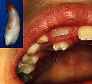 Überzähliger Zahn (Mesiodens)