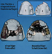 Parodontal-gingival getragene Prothesen