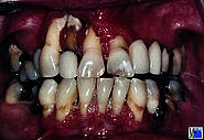 Wegenersche Granulomatose. Die granulierende Gingivahyperplasie nekrotisierte innerhalb von fünf Wochen zusammen mit dem parodontalen Knochen