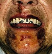 Mund- und Gesichtsverletzungen nach Sturz