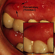 Fistelrückbildung nach Wurzelkanalbehandlung