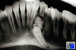 Komplexes Odontom