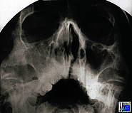 Polypöse Sinusitis maxillaris mit Verschattung der rechten Kieferhöhle