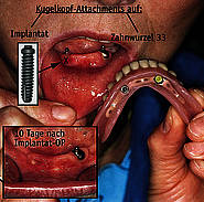 Kugelkopf-Halteelement auf künstlicher Zahnwurzel bei 43 (Implantat)