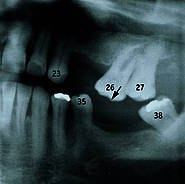 Zahnverlust mit Elongation Zahn 26 und Kippung Zähne 26, 38