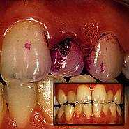 Plaqueablagerungen am Zahn 22