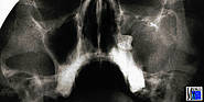 Operationsfoto bei antronasaler Zystostomie einer follikulären Zyste mit der in das Zystenlumen hineinragenden Krone des nach medial verdrängten 28