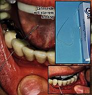 Spezielle Zahnseide mit starrem Anfang