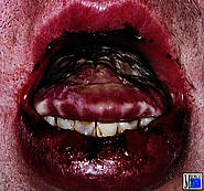 Arzneimittelexanthem unter dem Bilde eines Erythema exsudativum multiforme