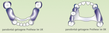 Parodontal getragene Prothesen