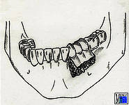 Alveolarfortsatzfraktur