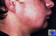 Cheilitis granulomatosa bei Melkerson-Rosenthal-Syndrom