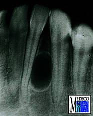 Laterale parodontale Zyste. Die angrenzenden Zähne sind vital.