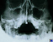 Partielle Verschattung der rechten Kieferhöhle bei chronischer Sinusitis