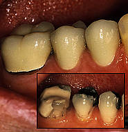 Kronentherapie an 44-45-46
